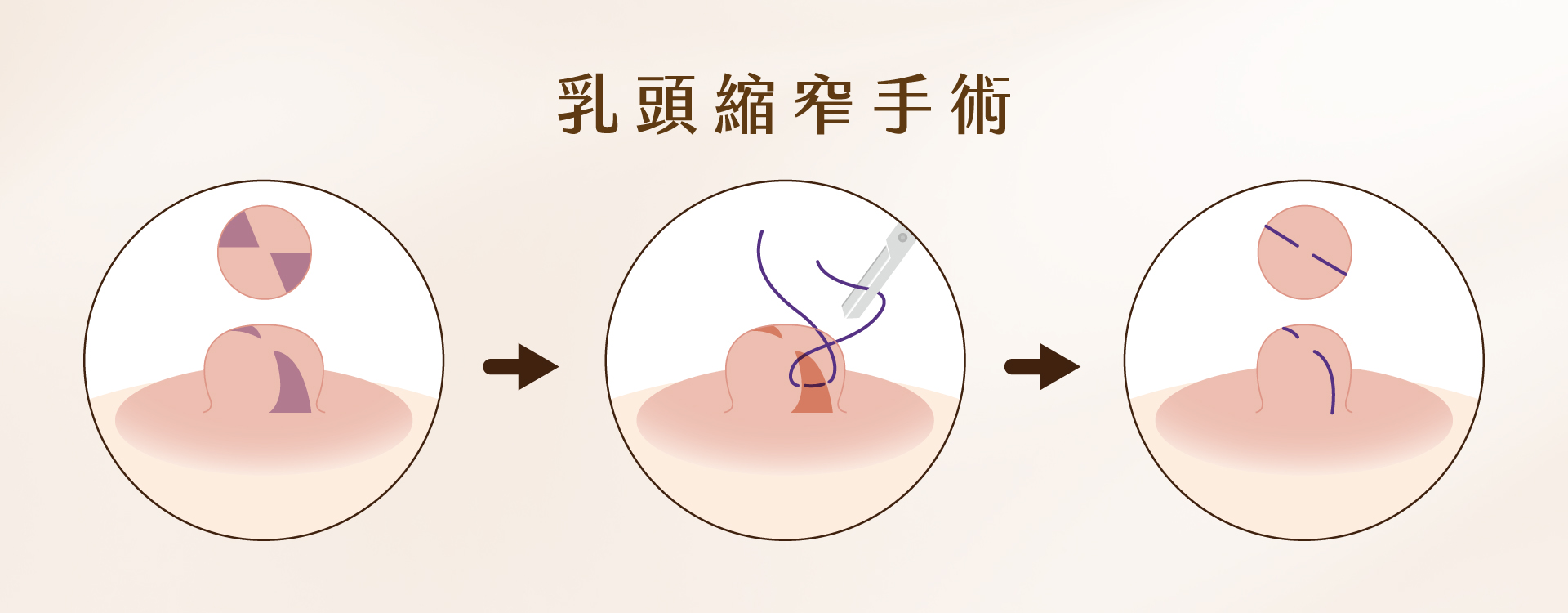 提乳手術 提乳手術