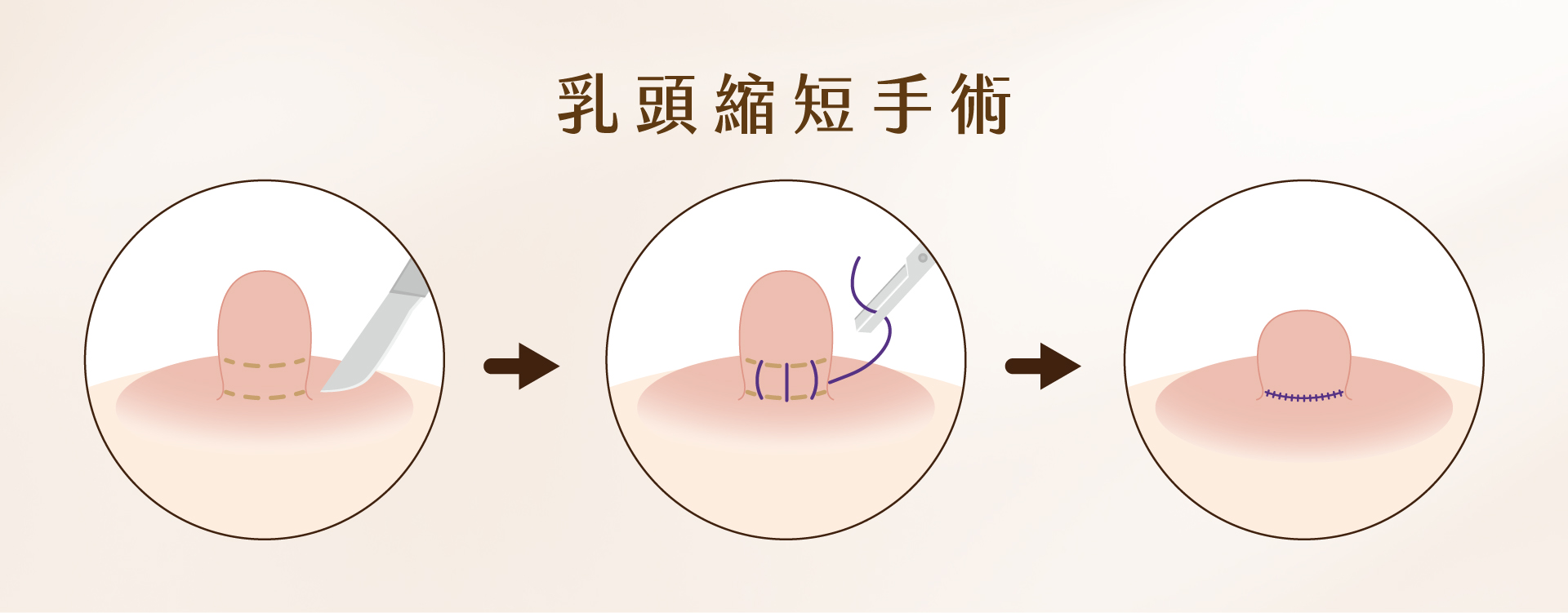 提乳手術 提乳手術