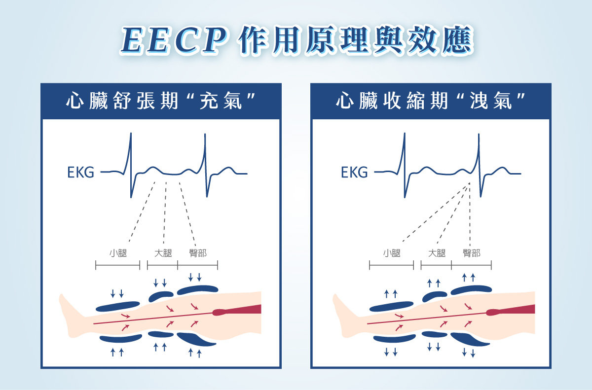 EECP 體外反搏 EECP 體外反搏