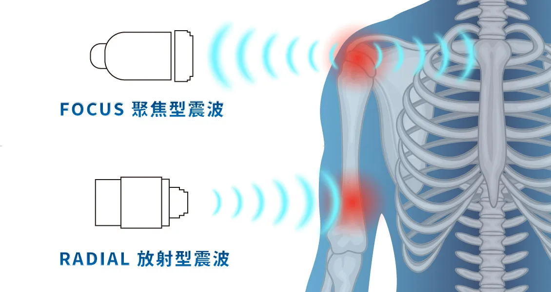 震波治療 (攝護腺保養)