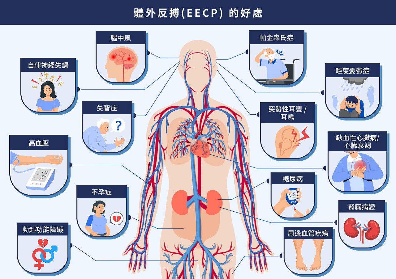 EECP 體外反搏