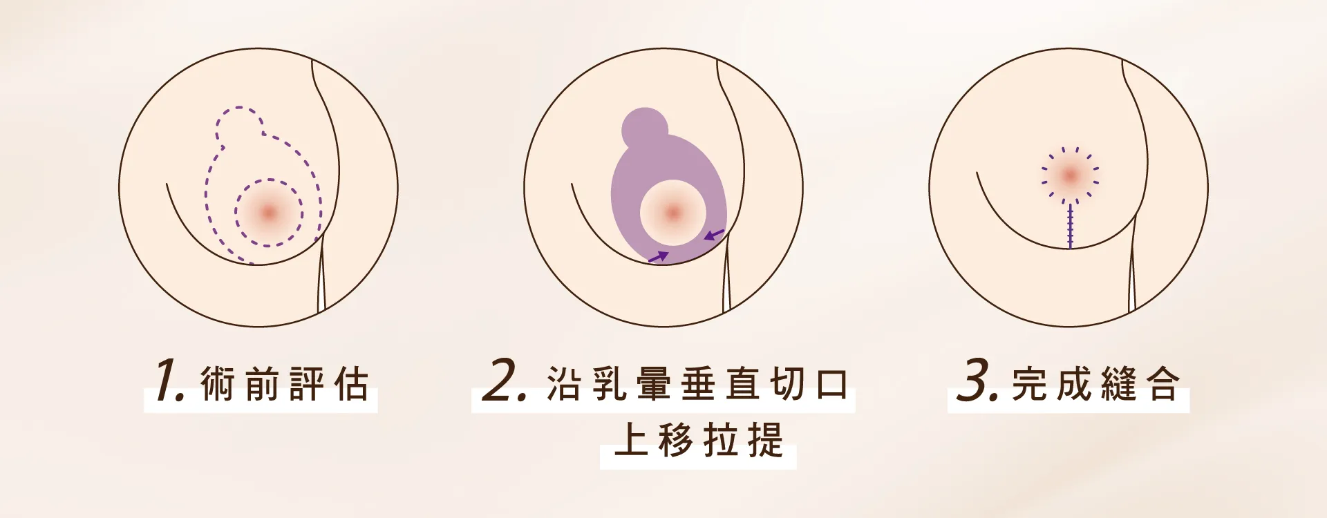 提乳手術 提乳手術