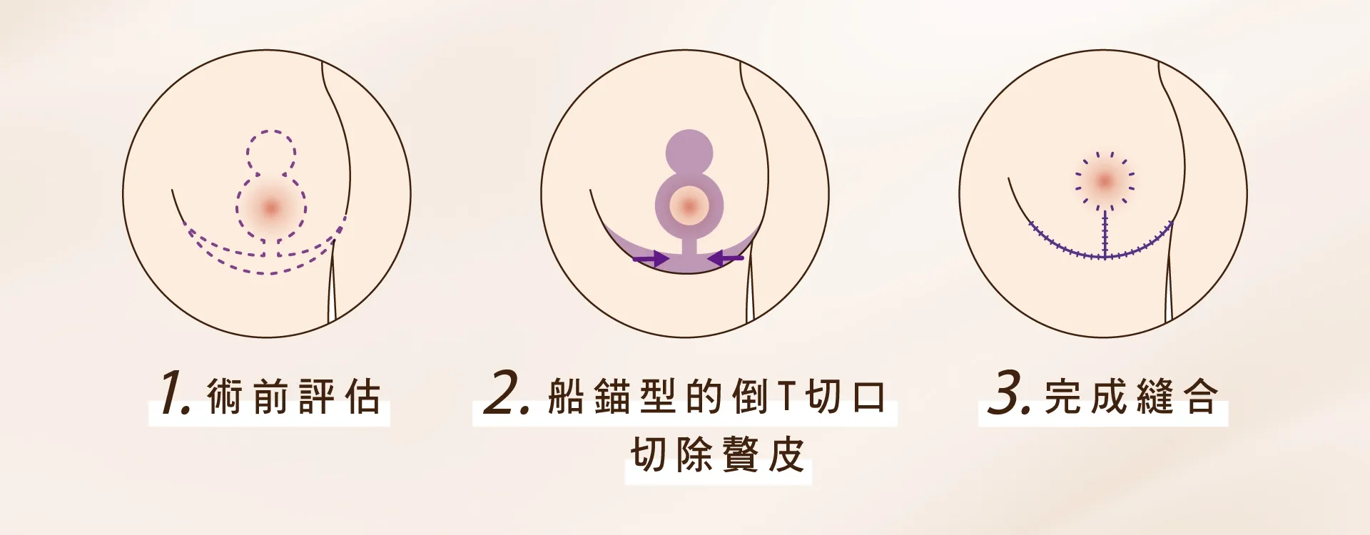 提乳手術 提乳手術