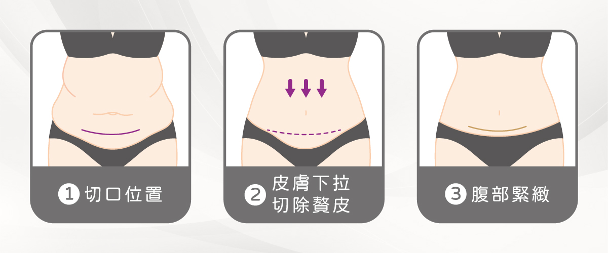 腹部拉皮 腹部拉皮