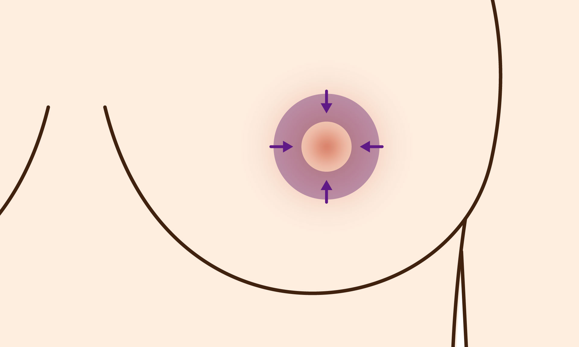 提乳手術