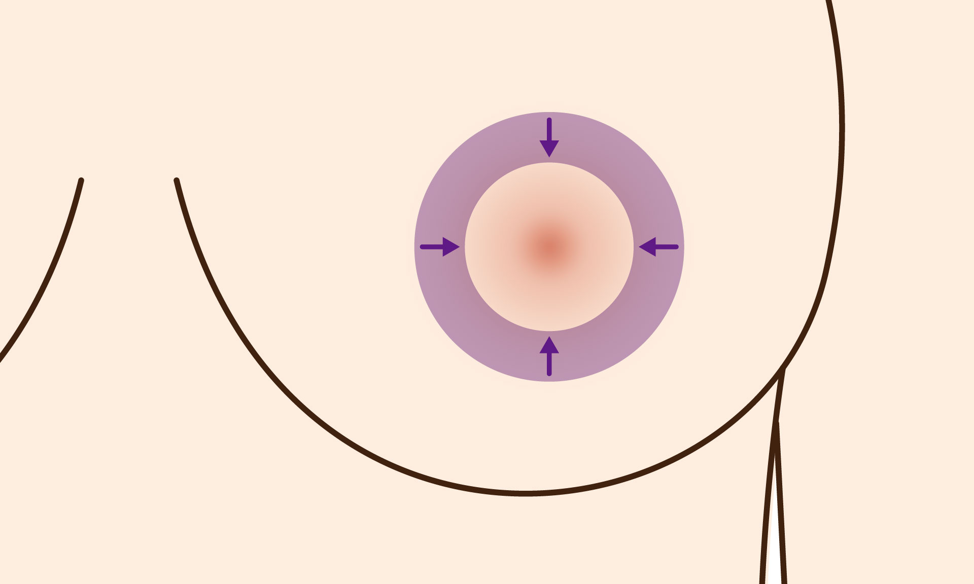 提乳手術