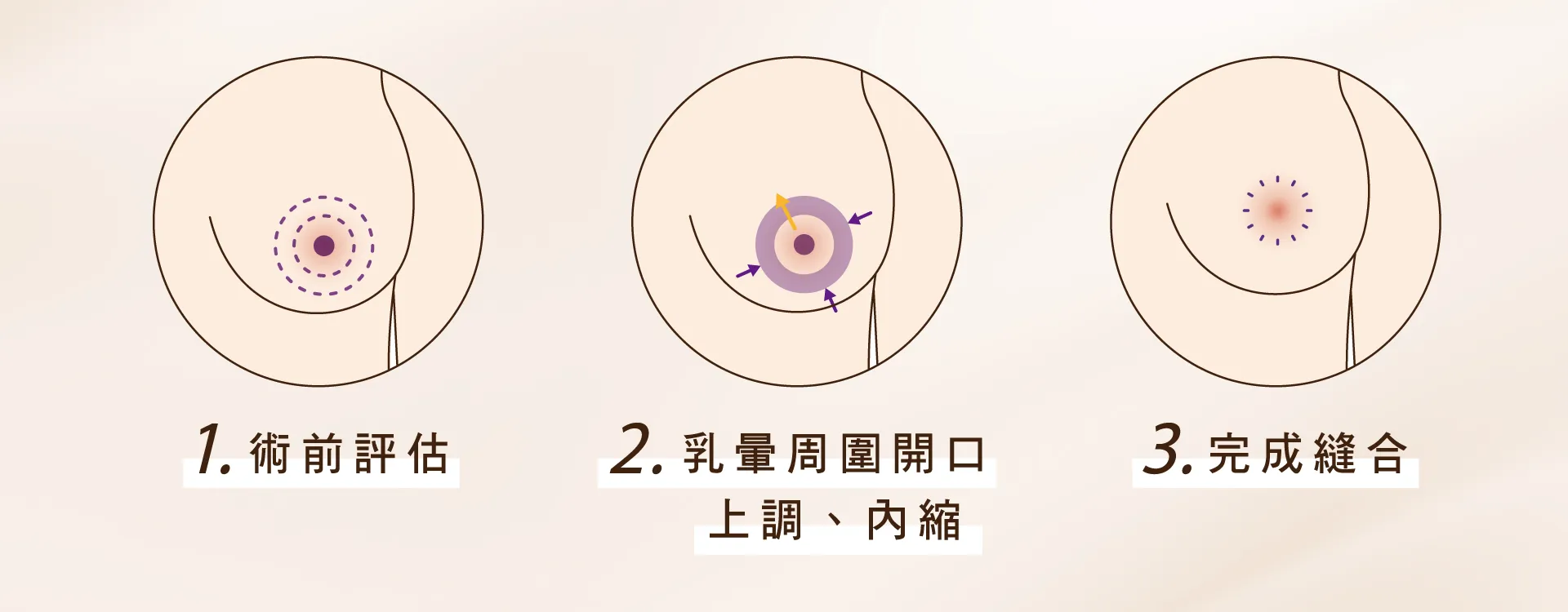 提乳手術 提乳手術