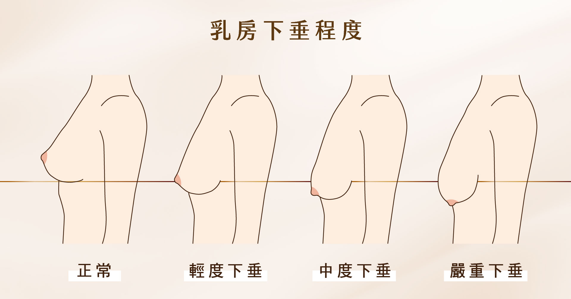 提乳手術