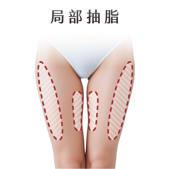 大腿環抽 大腿環抽
