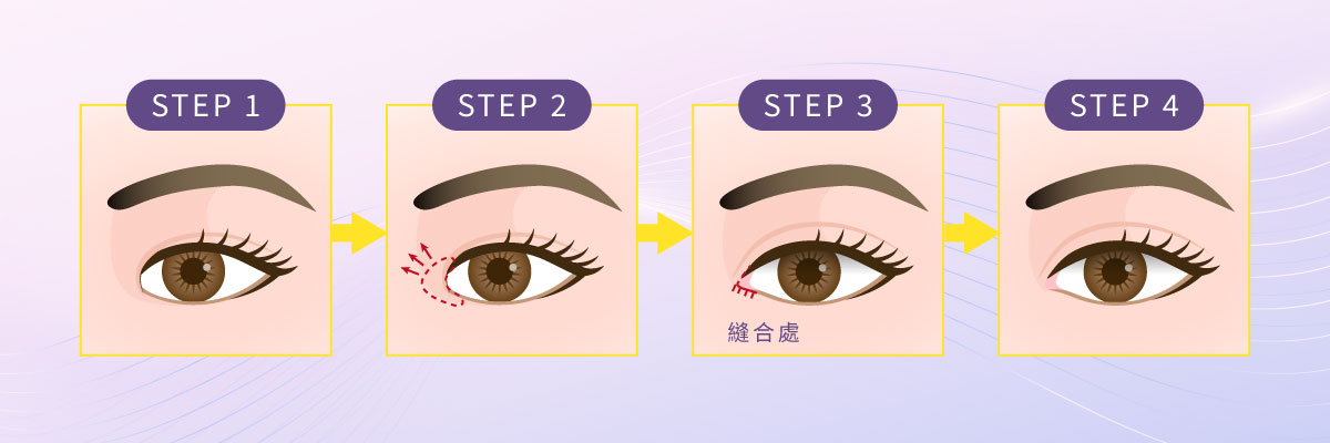 開眼頭/眼尾手術 開眼頭/眼尾手術