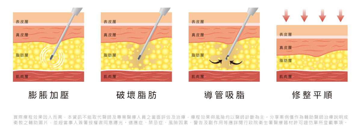 大腿環抽