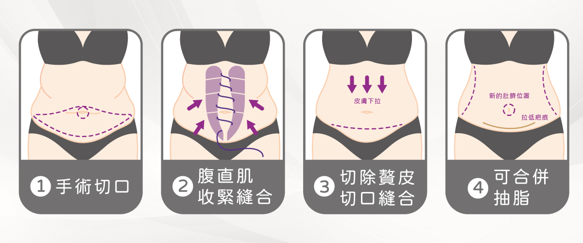 腹部拉皮 腹部拉皮