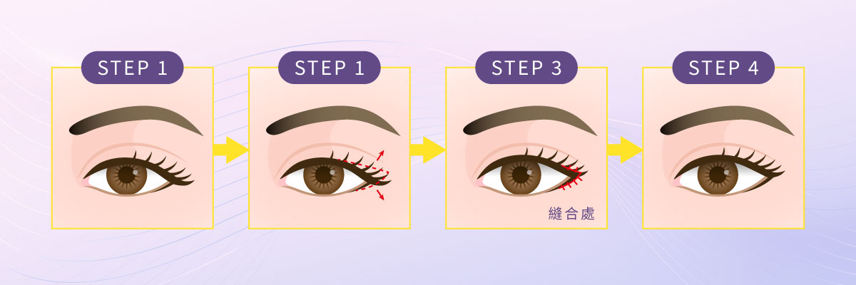 開眼頭/眼尾手術 開眼頭/眼尾手術