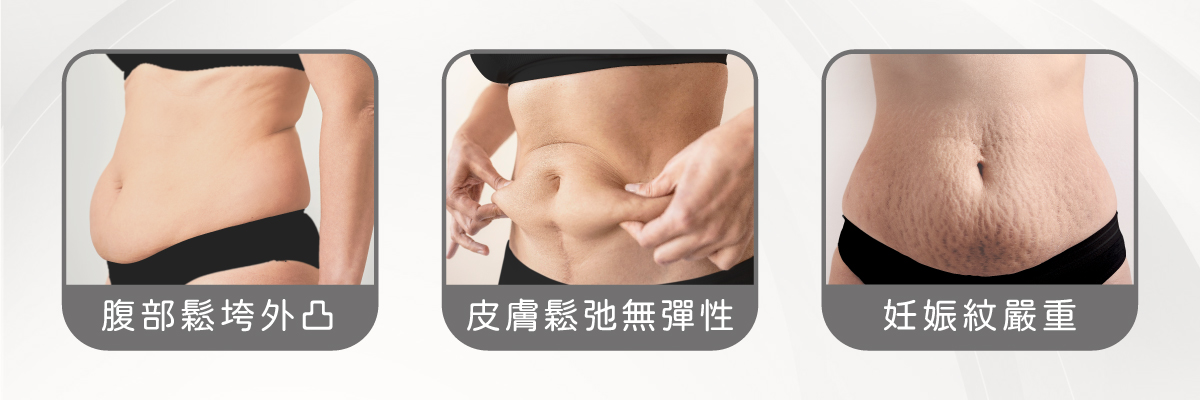腹部拉皮 腹部拉皮