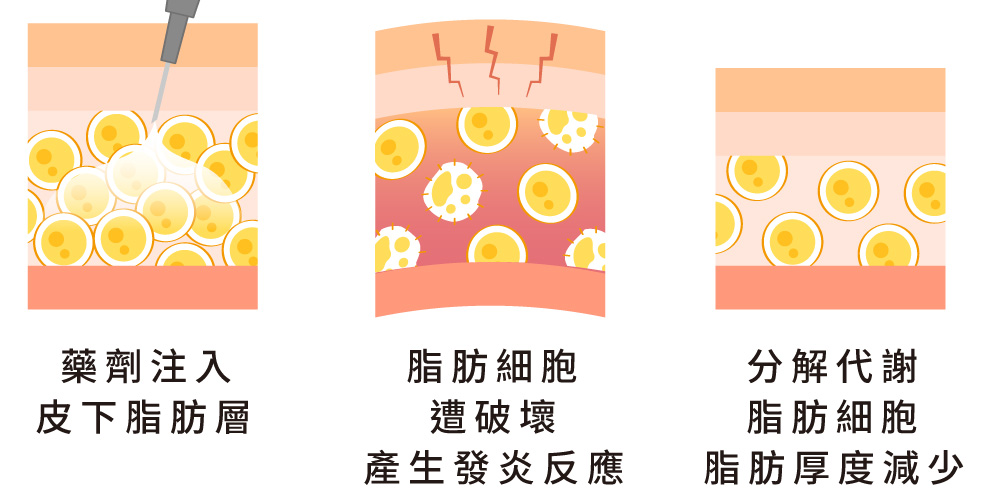 溶脂針 Ronkyla