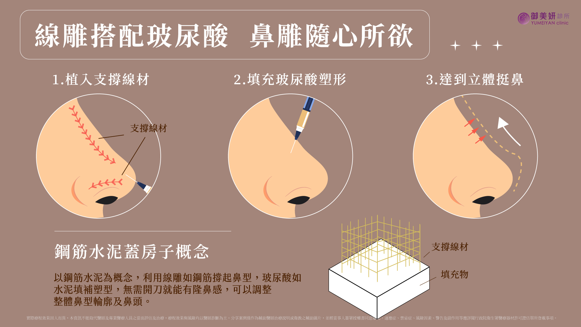 線雕隆鼻 線雕隆鼻