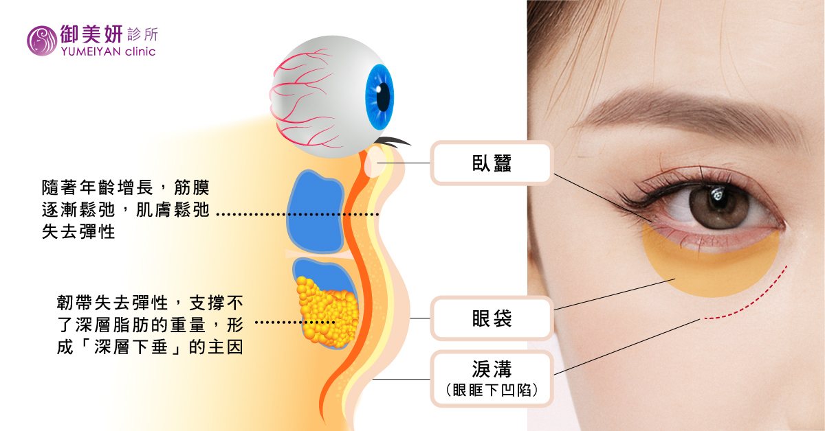 眼袋、淚溝和臥蠶的分辨 眼袋、淚溝和臥蠶的分辨