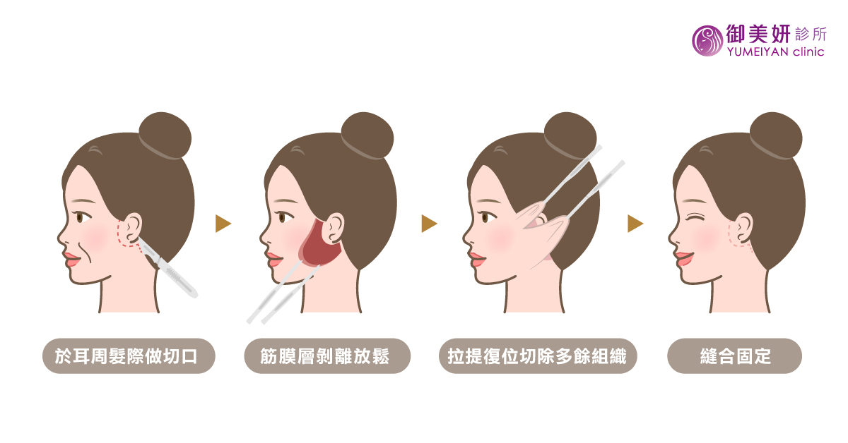 多層次深層筋膜 拉皮手術 多層次深層筋膜 拉皮手術