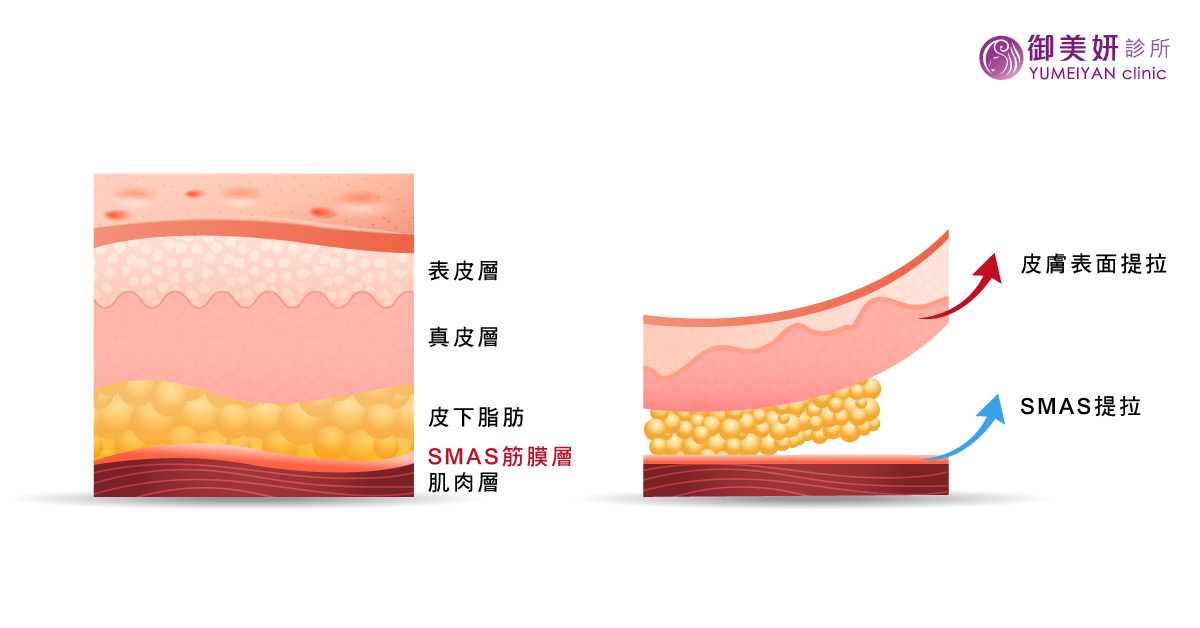 多層次深層筋膜 拉皮手術 多層次深層筋膜 拉皮手術
