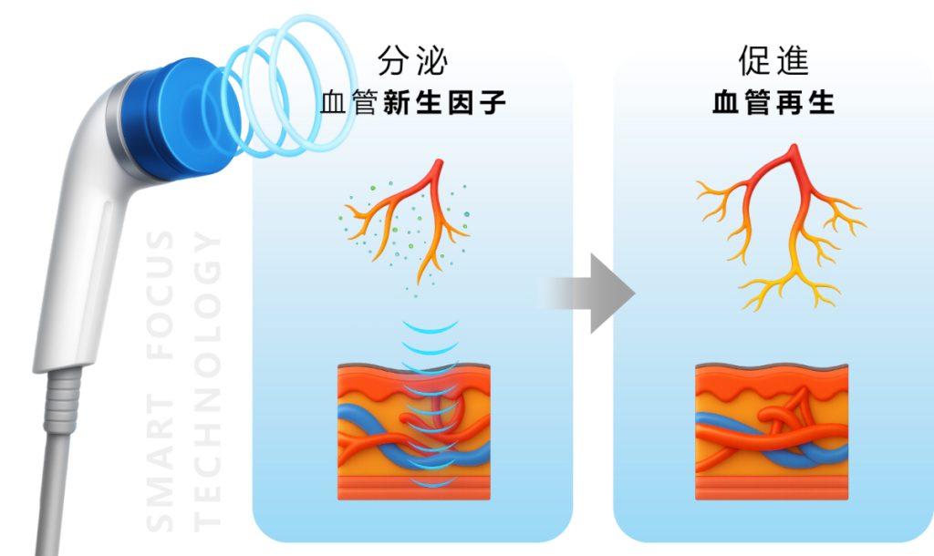 體外震波治療是什麼？適合哪些男性？