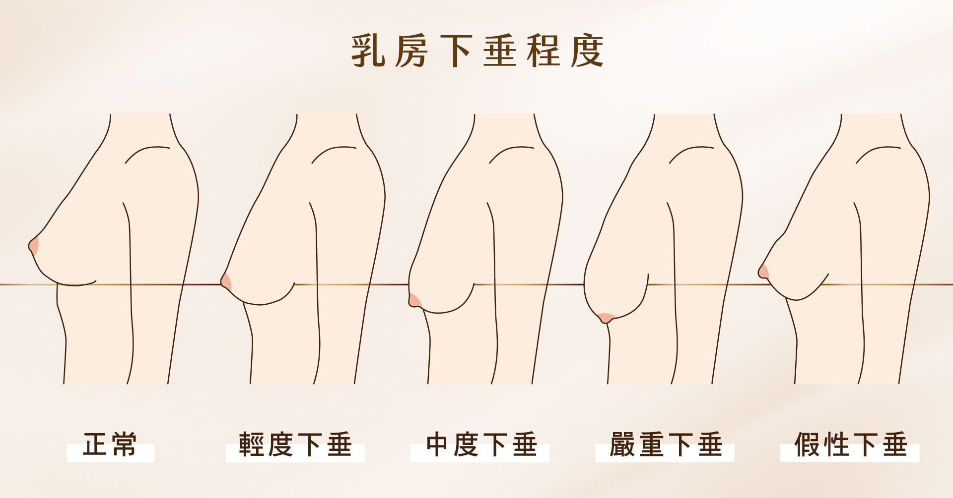 乳房下垂程度